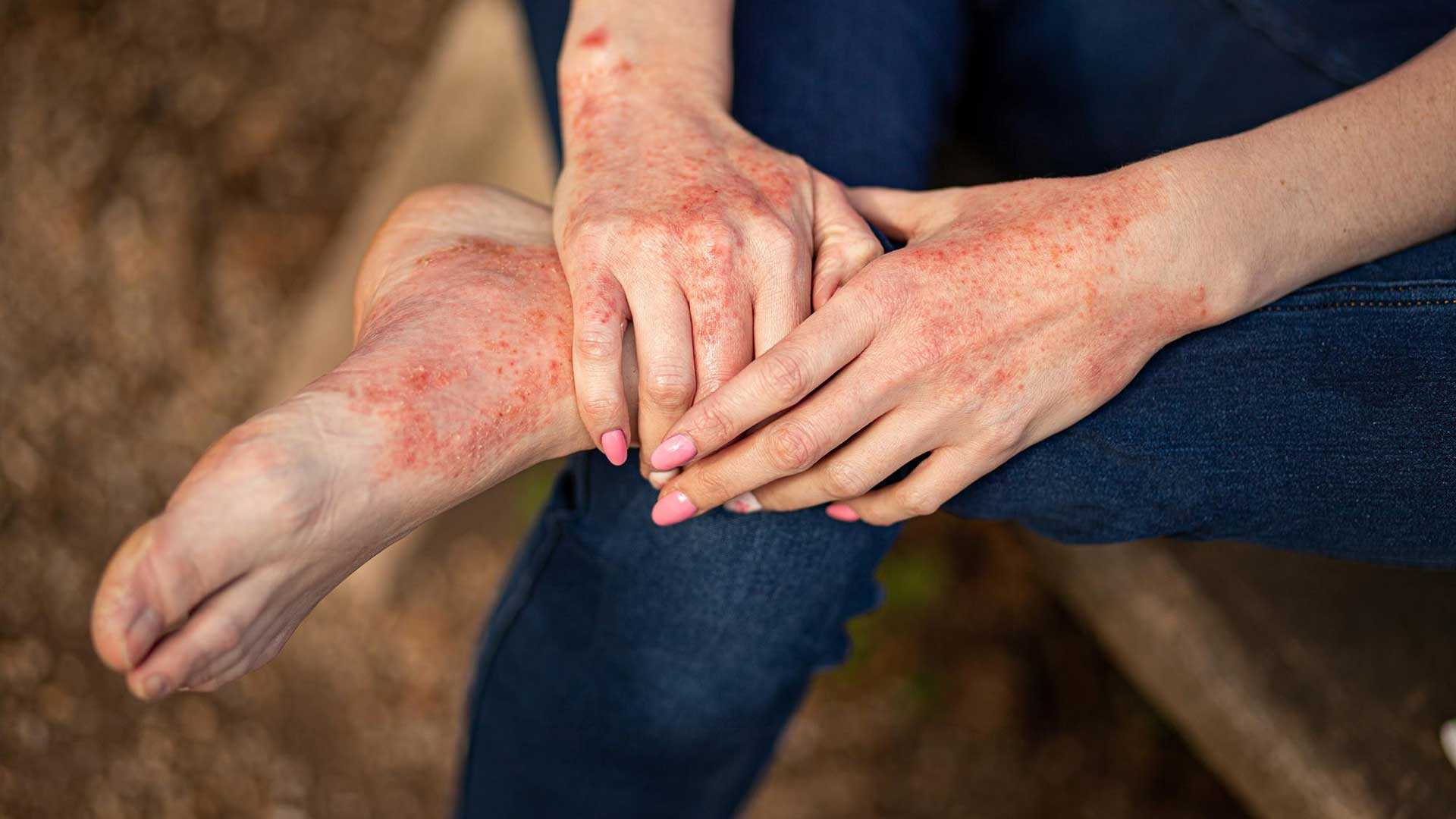 Background image for Eczema Hypnotherapy