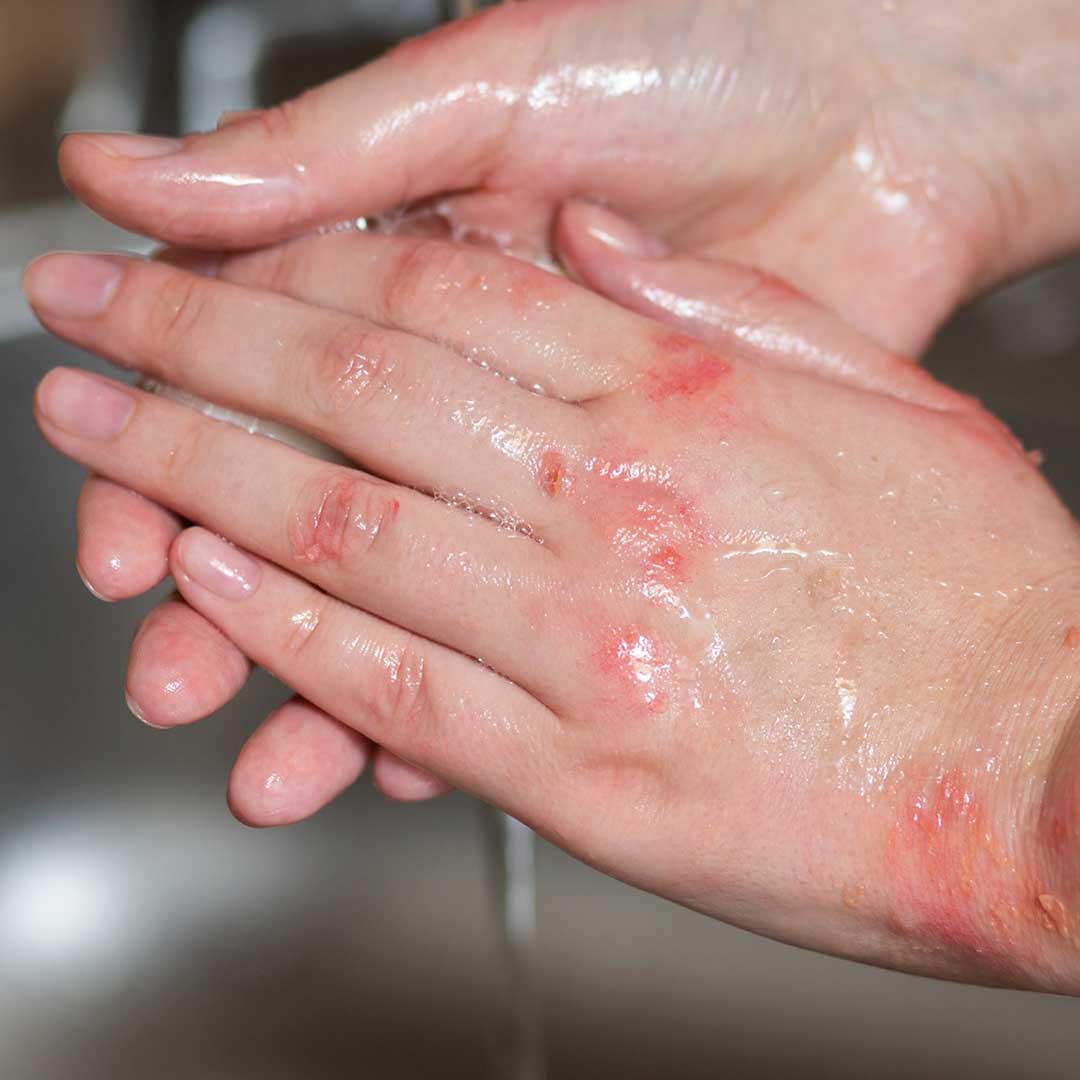 Obsessive Compulsive Disorder (OCD)