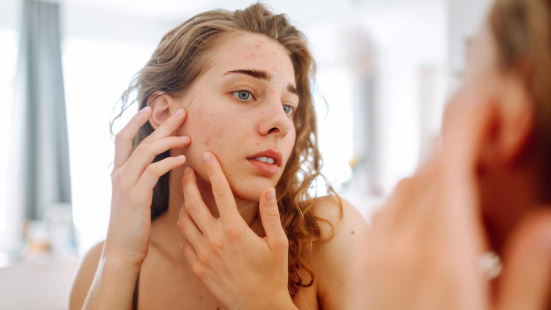 Background image for Skin Picking (Dermatillomania) Hypnotherapy