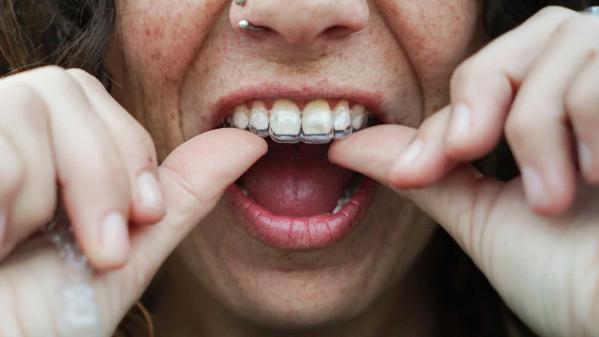 Personalised Self-Hypnosis – Teeth Grinding (Bruxism)